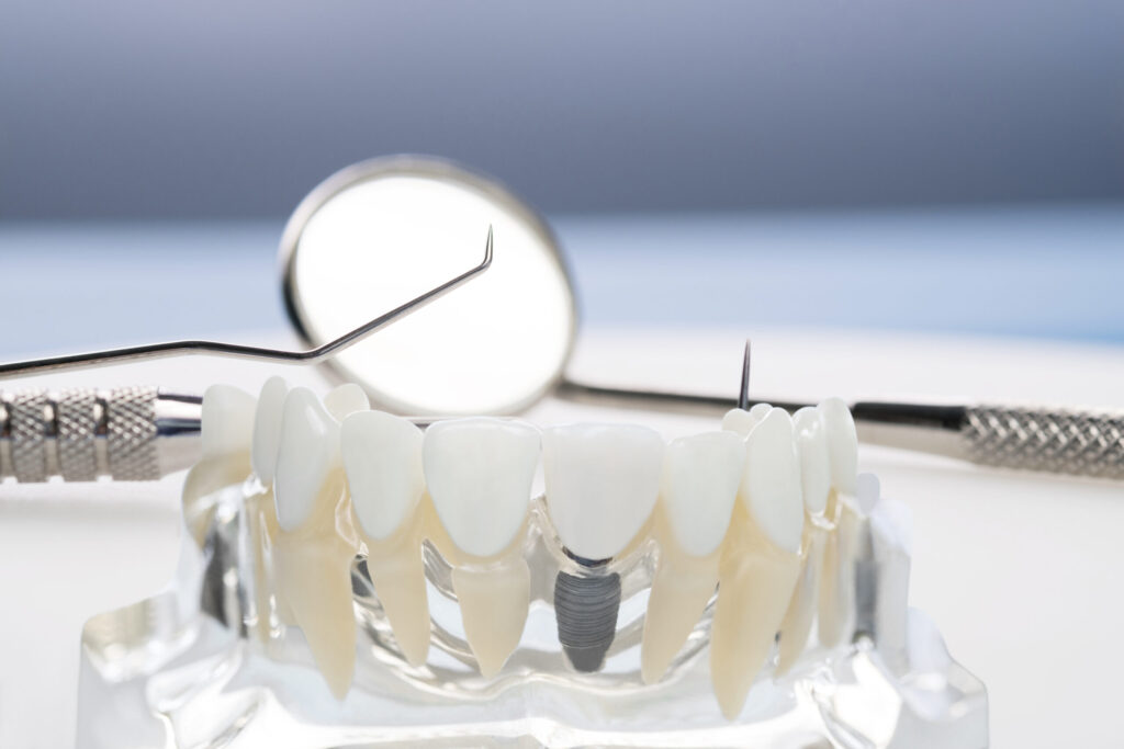 CZY WSTAWIANIE IMPLANTÓW BOLI? CZY WSTAWIANIE IMPLANTÓW BOLI?CZY WSTAWIANIE IMPLANTÓW BOLI?CZY WSTAWIANIE IMPLANTÓW BOLI?